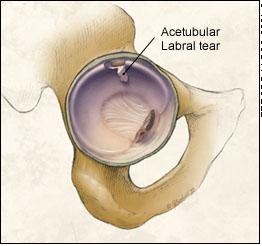 Labral tear.JPG